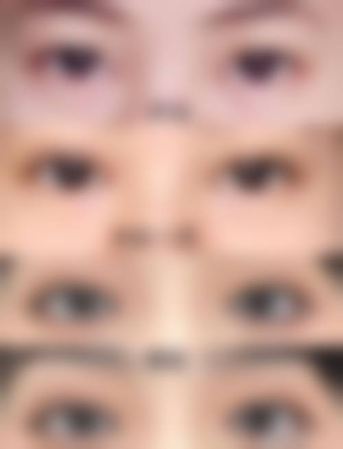 田克岭眼部整形实例