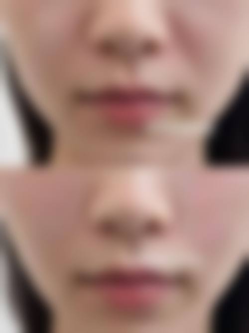 郭阿敏微创注射美容水平怎么样可靠吗？