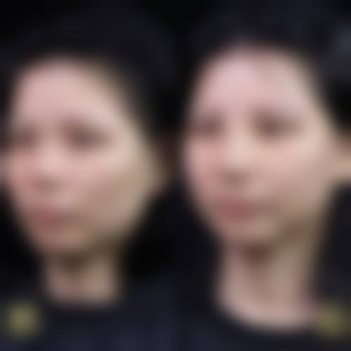 王见平双眼皮手术实例