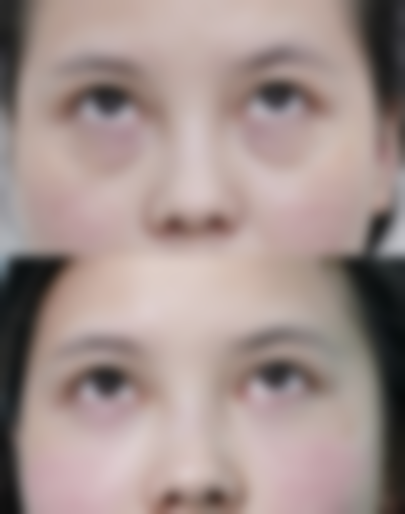 田克岭眼部整形水平怎么样可靠吗？