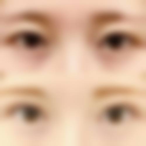 肖文明眼部整形实例