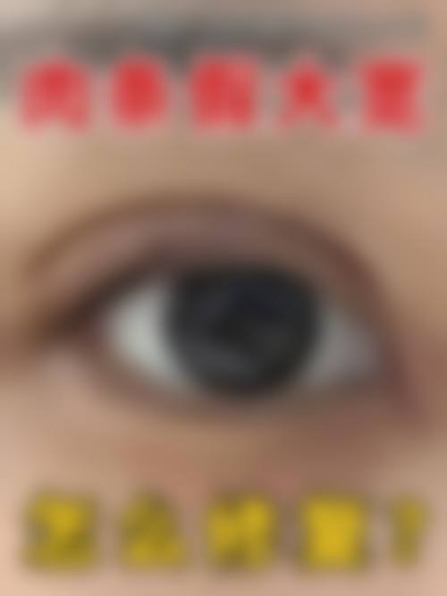 王晨光眼部综合整形实例