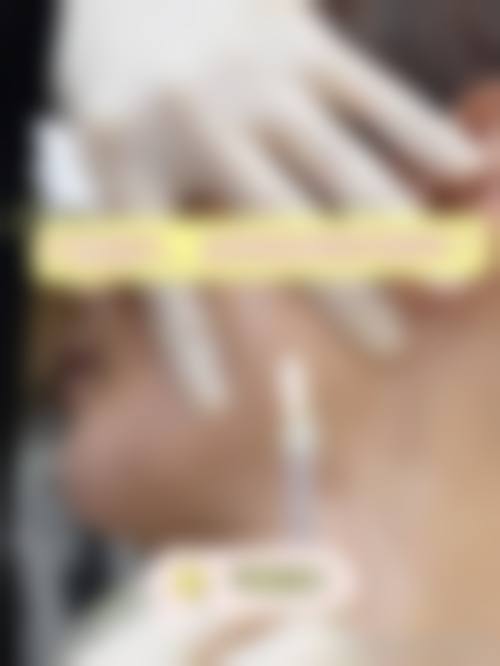 李美肉毒素瘦脸实例