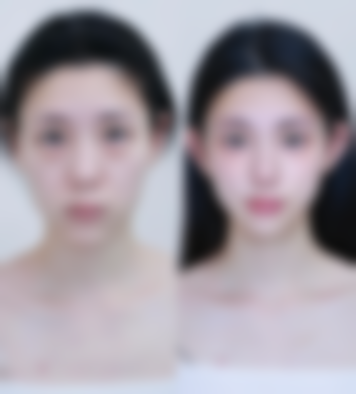 王晨光眼部综合整形水平怎么样可靠吗？