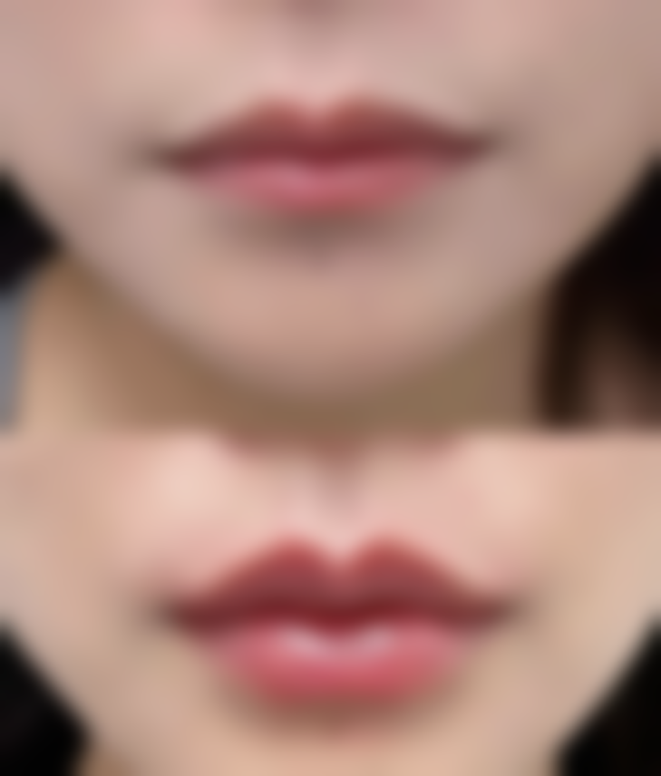 想睡出双眼皮？正规医院优势多