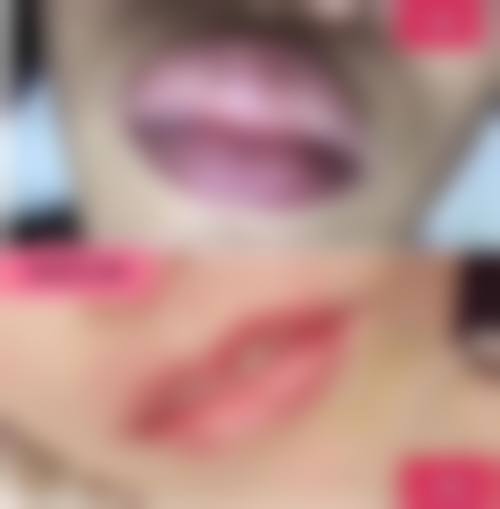 多种治疗手段齐上阵，改善凹陷成效好