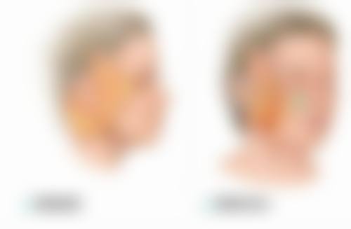 面部除皱选肉毒素与填充针！肉毒素——动态纹的克星