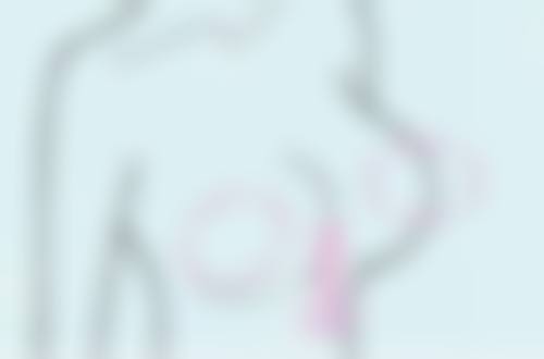 美学设计特别重要，修复疤痕更自然