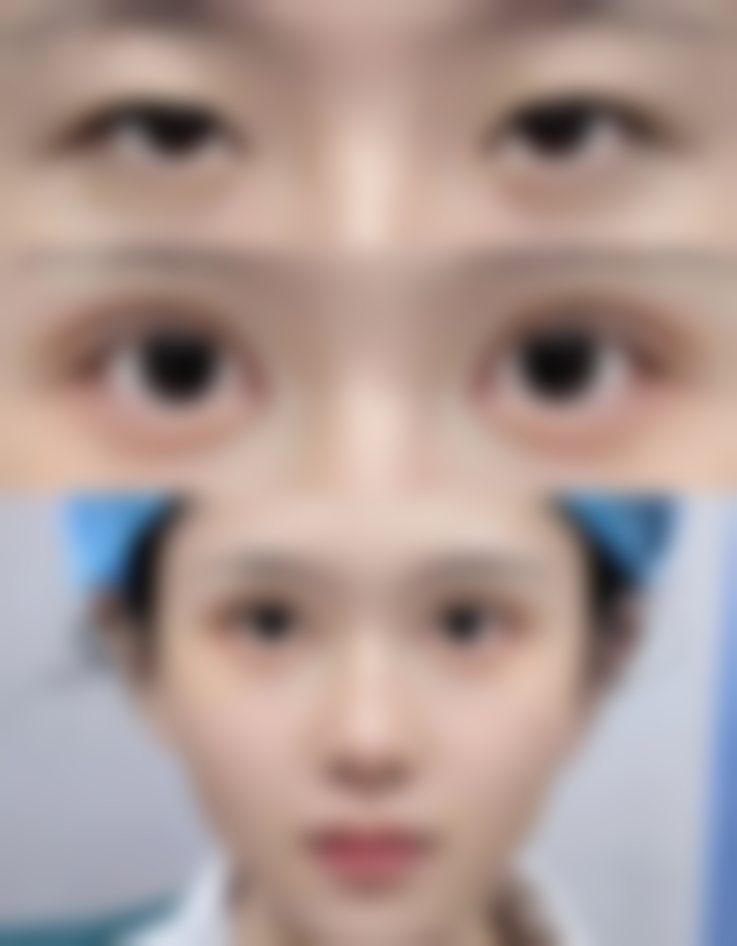 治疗增生疤痕的具体成效