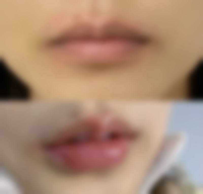 揭秘开扇型双眼皮：对比其他类型，优势一目了然