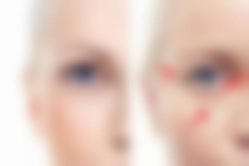 埋线与全切双眼皮怎么选？成效持久性来帮忙