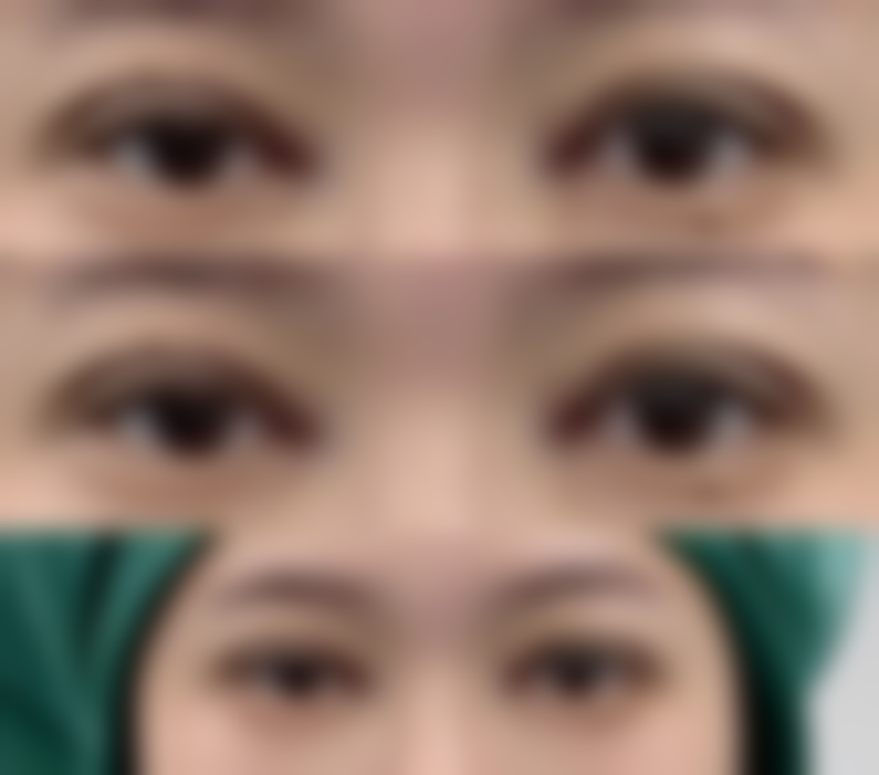 瘦脸针打完后反应大揭秘：后续护理与成效巩固要点