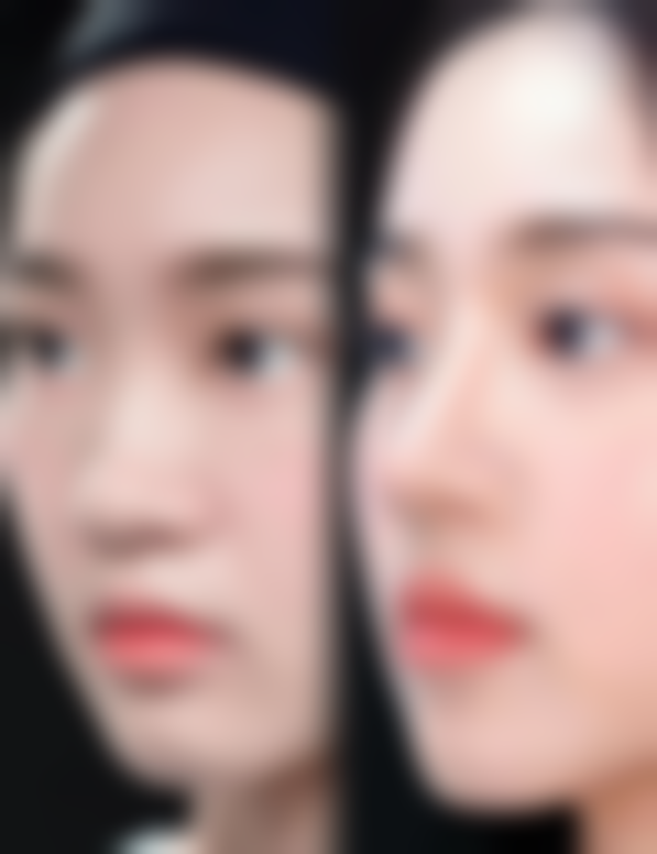 宝尼达隆鼻修复小贴士，助你快速达至佳状态