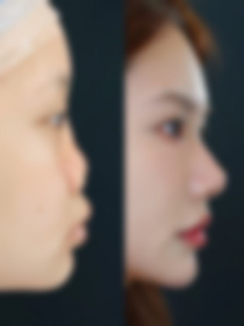 瘦脸针打完后反应大揭秘：成效显现期的惊喜变化