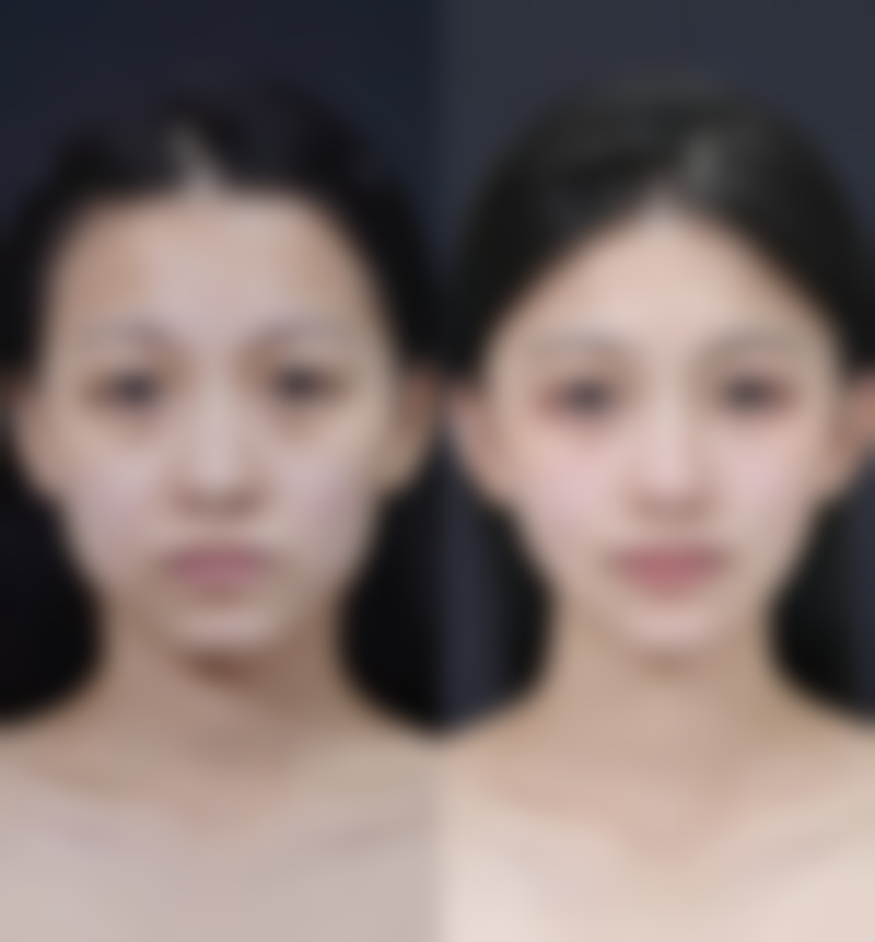 手术疤痕增生怎么搞？压力治疗来帮忙