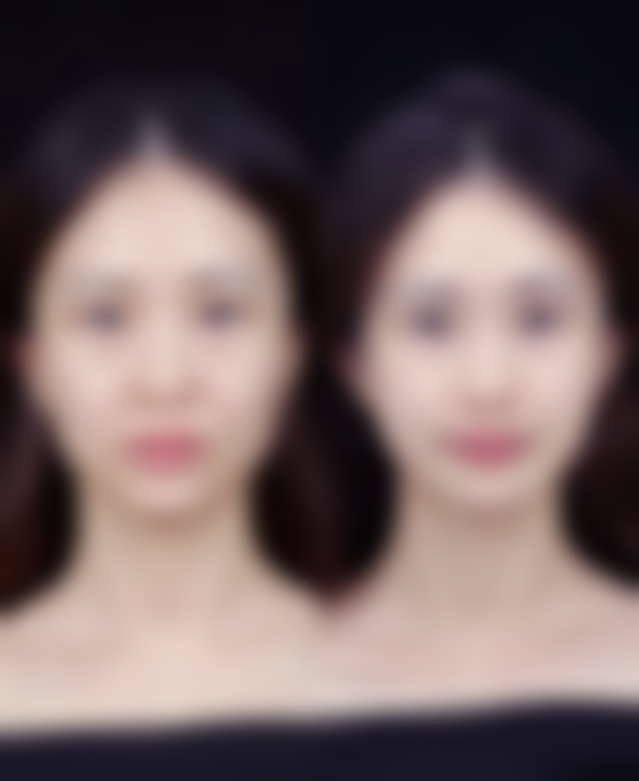 二次种植发际线间隔多久合适？术后护理保护成效呈现