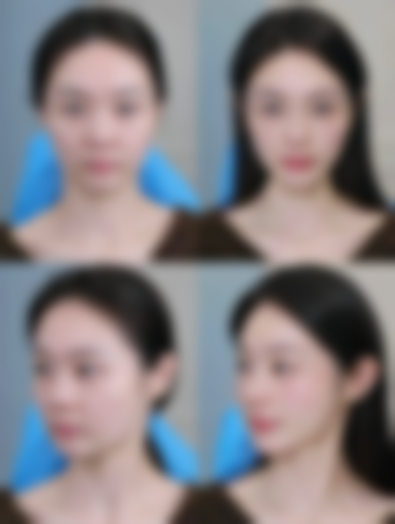 埋线与全切双眼皮怎么弄？专精建议不能忘