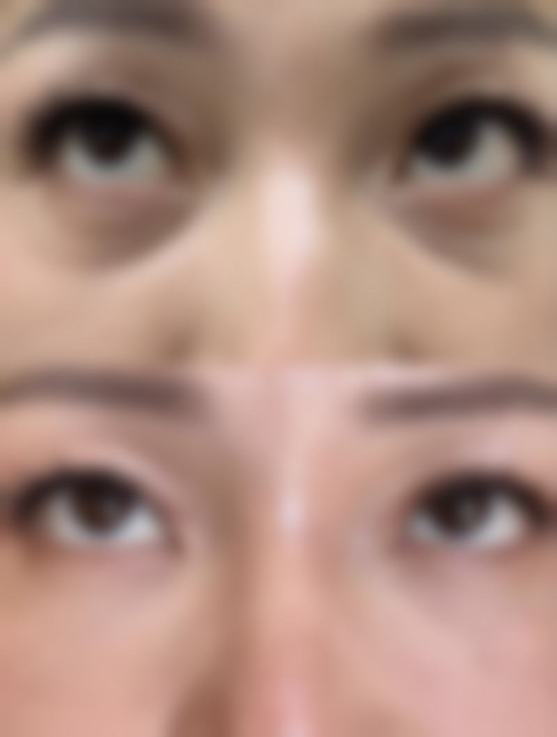 二次种植发际线间隔多久合适？选择靠谱医院助力成功