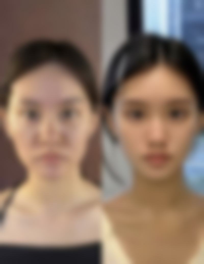 埋线与全切双眼皮咋抉择？修复时间大揭秘