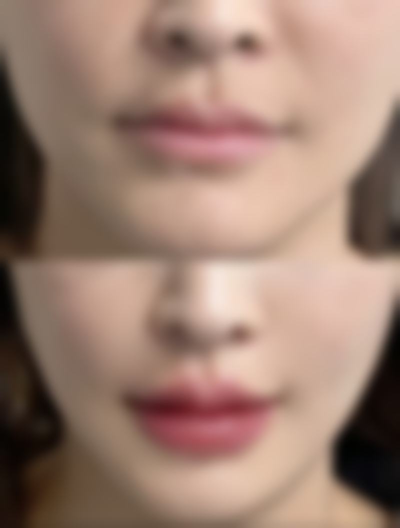 疤痕体质做激光：术后护理和风险控制特别重要