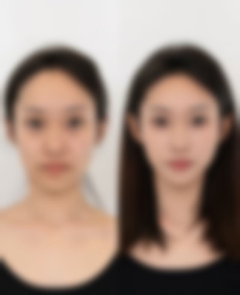 割双眼皮后多久能洗脸、修复？了解不同阶段恢复时间，开启美丽蜕变之旅 