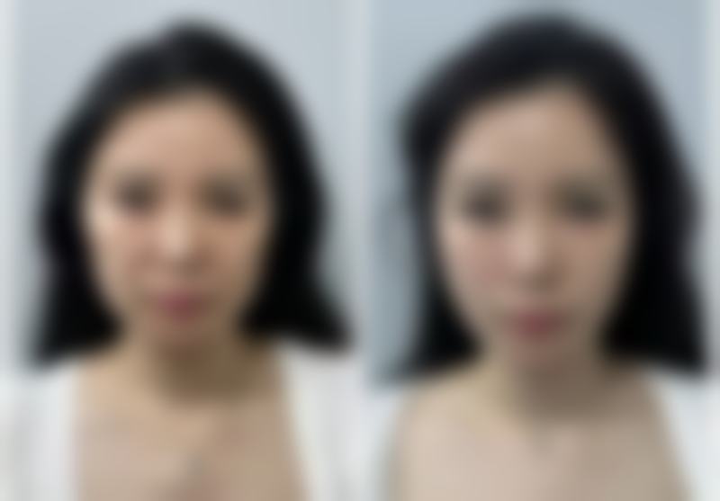 去眼袋至佳体验揭秘：医院环境与服务