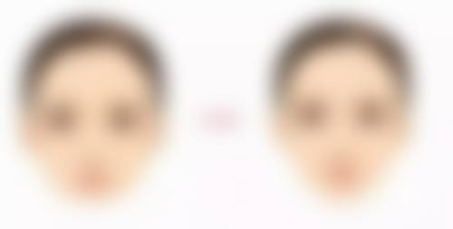 割双眼皮后遗症揭秘：术后护理要点