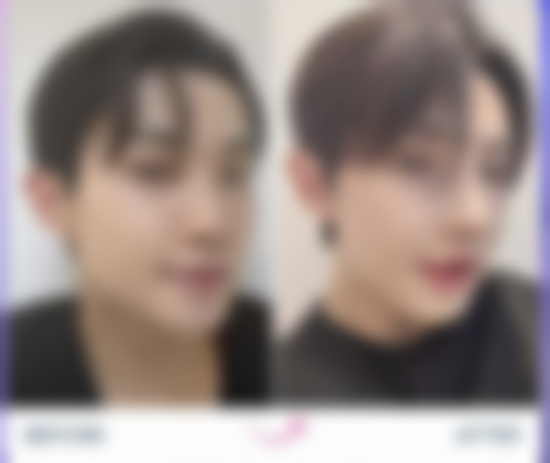 割双眼皮后各阶段修复情况及翻白眼注意啥？