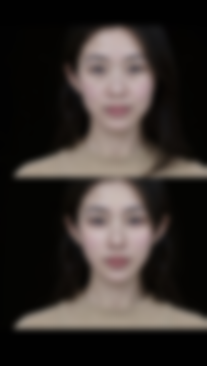 割双眼皮后遗症揭秘：罕见但需警惕的风险