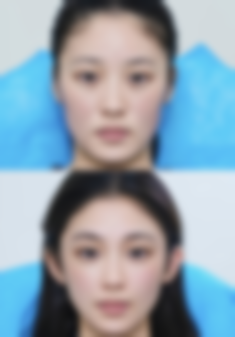 注射隆胸后能否喂母乳？切口位置也有讲究