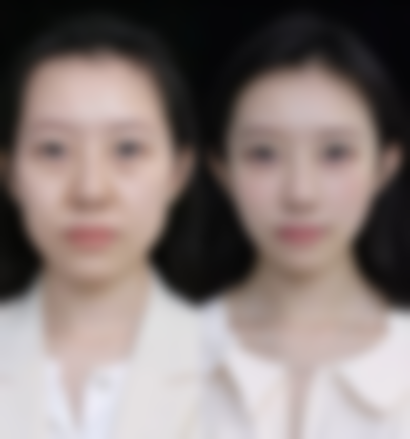 注射隆胸后能否喂母乳？专业解析影响因素与保障母婴健康的秘诀 