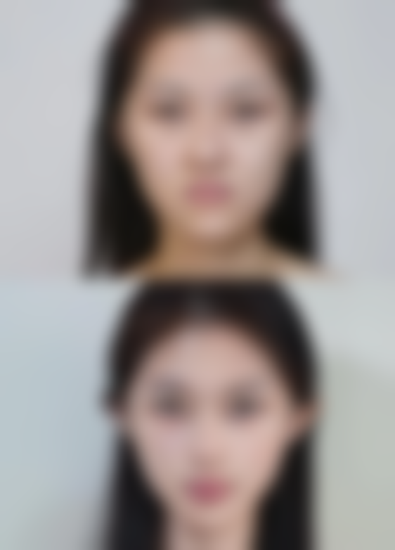 假体隆胸260cc：不同乳房基础组织量的差异