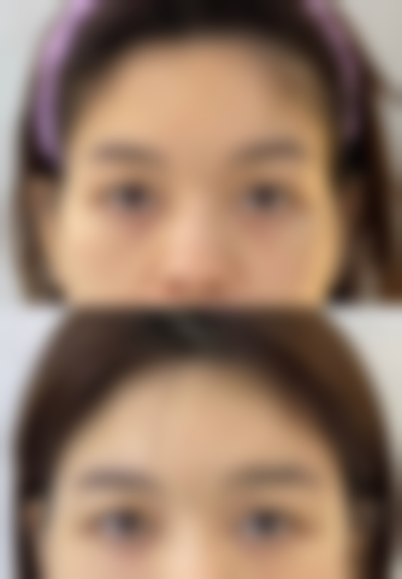 假体隆胸260cc：选择它的优势有哪些