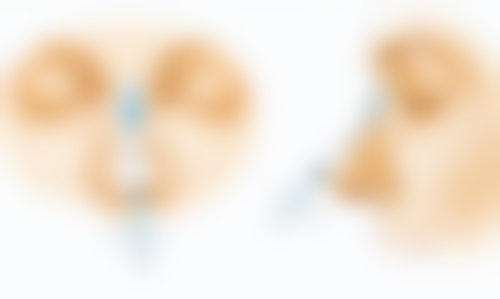 割过双眼皮留疤别慌！稳定期修复方案来帮忙