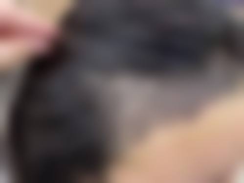 徐开业毛发种植实例