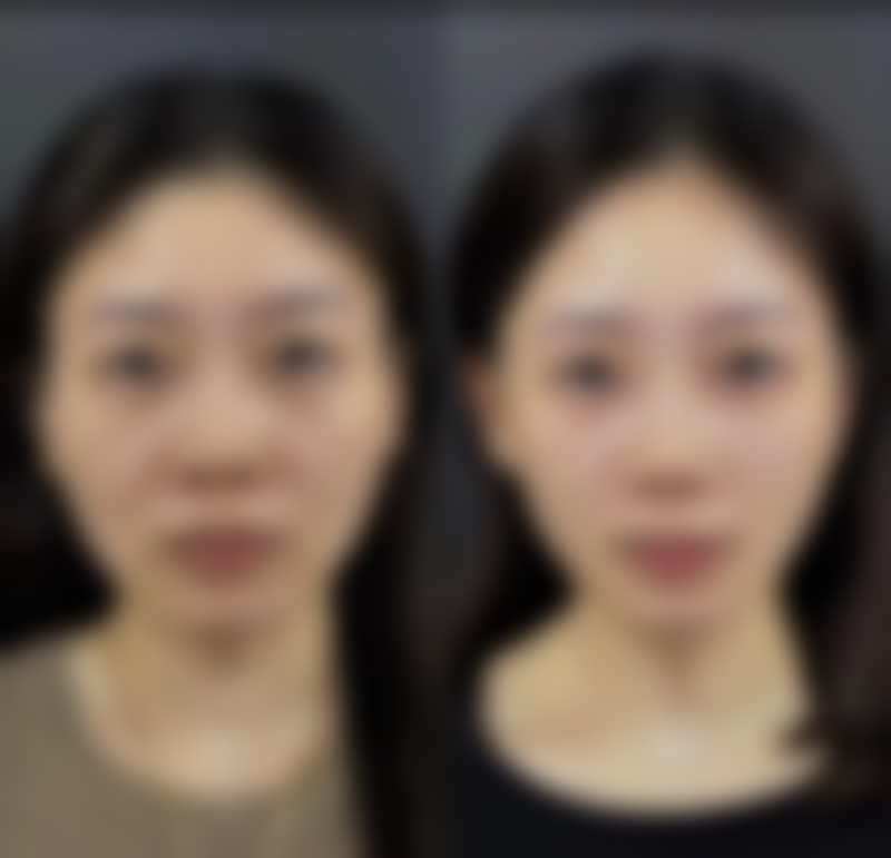 割过双眼皮留疤别忧！日常护理助力修复