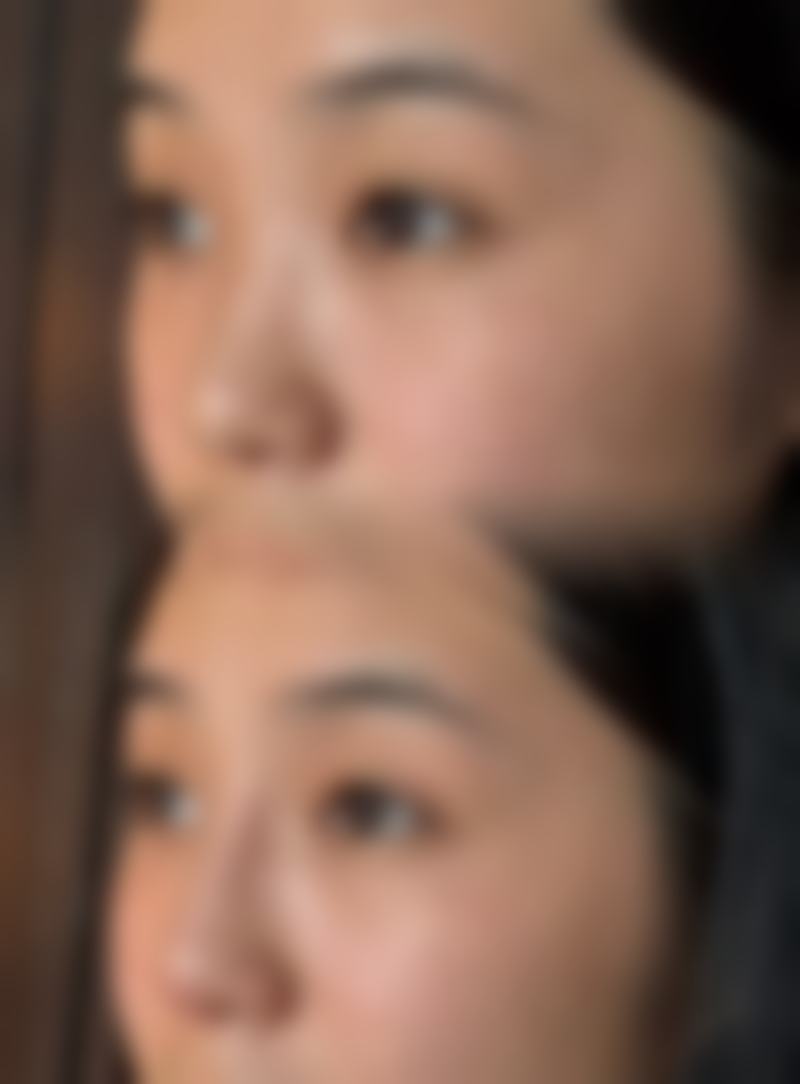 割过双眼皮留疤别愁！多种修复方案兼顾流畅对称，助你重获理想眼部状态 