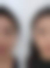 揭秘去除疤痕疙瘩的方法:专精医院的重要性