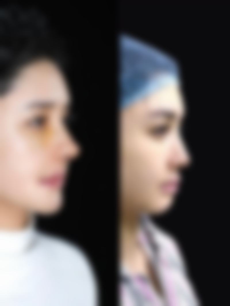 做完双眼皮眼睛和眉毛更近?改善方法多样