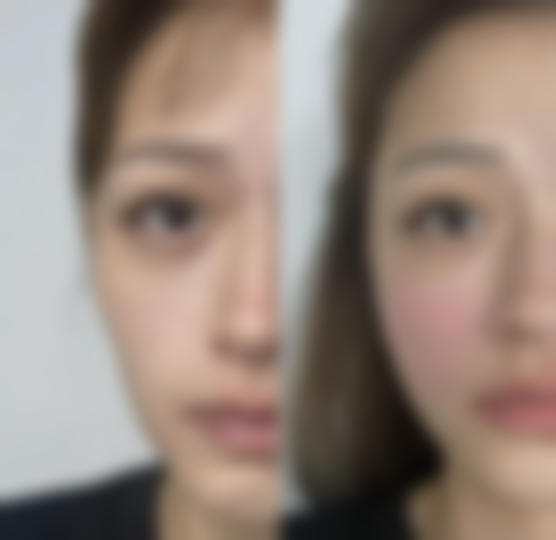 怎样有效去除眼袋？多种医美方案+日常护理，持久焕亮眼周光彩 