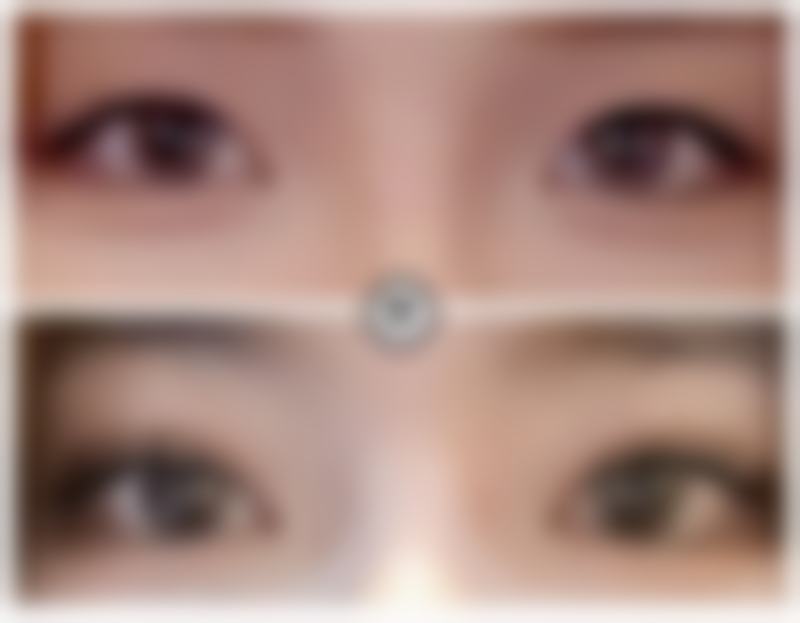 做完双眼皮眼睛和眉毛更近?保持好心态等修复