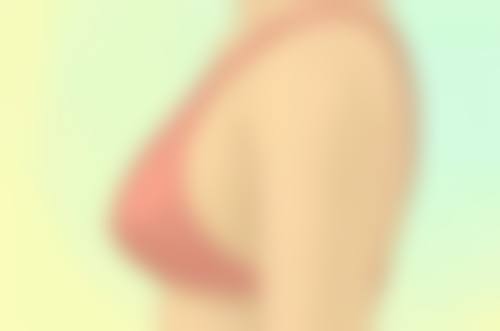 预防疤痕疙瘩的有效措施