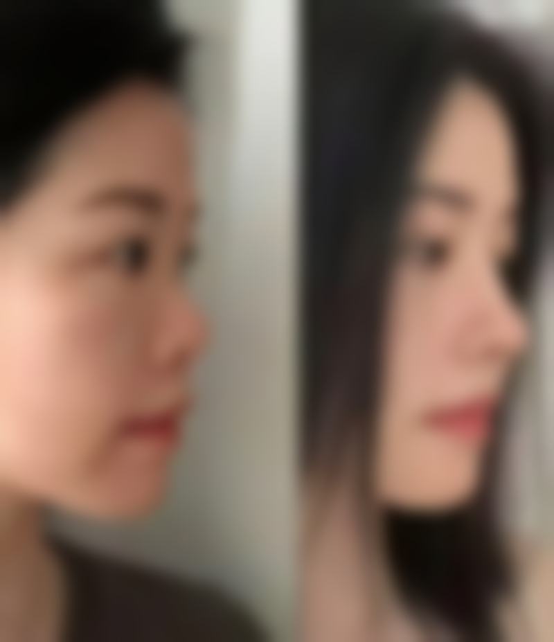 怎样实现自体脂肪隆胸出色成效？对比不同治疗方案