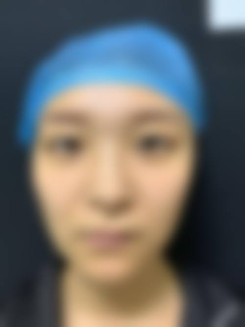 沈珍熙眼部整形实例