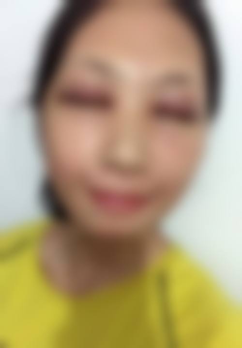 沈珍熙眼部整形项目价格表参考