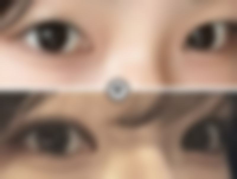 沈珍熙眼部整形水平怎么样可靠吗？