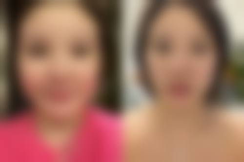 头发种植究竟好不好?显著改善外观与自信