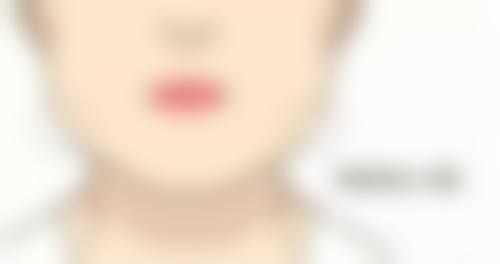 埋线双眼皮效果能维持多久？3 - 8 年因人而异，多种因素影响消失时间 