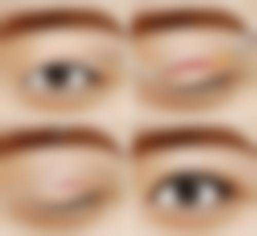 郑甫滥眼部整形实例