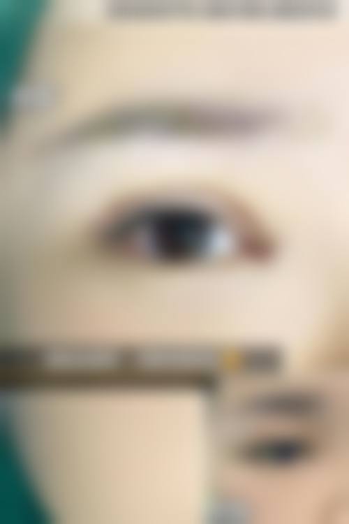 李惠圆眼部整形实例